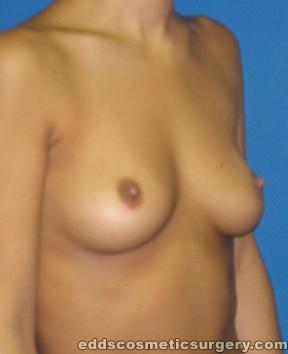 Breast Augmentation (Breast Implants) Before Picture 1