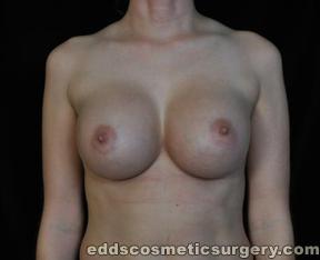 Breast Augmentation (Breast Implants) After Picture 1
