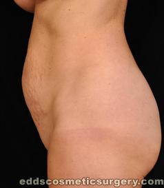 Tummy Tuck (Abdominoplasty) Before Picture 1