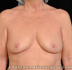Breast Augmentation (Breast Implants) Before Picture 1