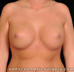 Breast Augmentation (Breast Implants) After Picture 1