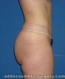 Tummy Tuck (Abdominoplasty) After Picture 1