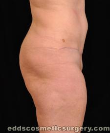 Tummy Tuck (Abdominoplasty) After Picture 1