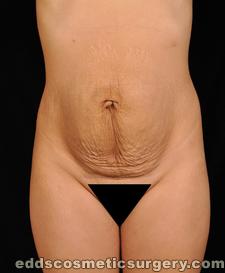 Tummy Tuck (Abdominoplasty) Before Picture 1