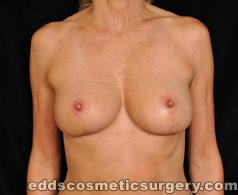 Breast Lift Surgery After Picture 1