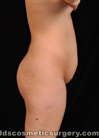 Tumescent Liposuction Before Picture 1