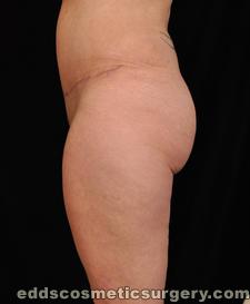 Tumescent Liposuction After Picture 1