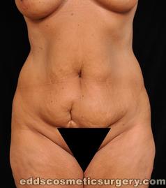 Tumescent Liposuction Before Picture 1