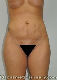 Tumescent Liposuction After Picture 1