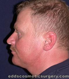 Chin Augmentation (Implants) After Picture 1