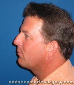 Neck Liposuction After Picture 1
