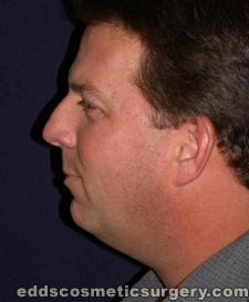 Neck Liposuction Before Picture 1
