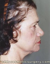 Face Lift Surgery (Rhytidectomy) Before Picture 1