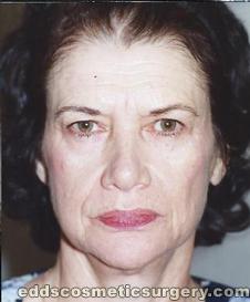 Face Lift Surgery (Rhytidectomy) Before Picture 1